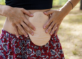 Colostomy UK Charity Receives IMPACT Award