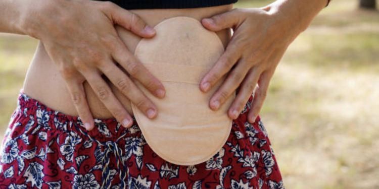 Colostomy UK Charity Receives IMPACT Award